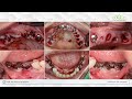 Full mouth implant placement with GBR - [Dr. Cho Yongseok]