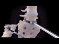 LP-ESP Surgical Technique 3D Video