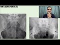 Ankylosing Spondylitis (AS) Treatment, Symptoms, Pathophysiology, Diagnosis, Medicine Lecture USMLE