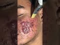 Black Peel Treatment For Acne | chemical peel for acne | acne treatment | Skinaa Clinic #shorts
