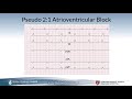 Long QT Syndrome by G. Dhillon | OPENPediatrics