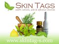 Skin Tag Removal in 15 Mins @ Home!