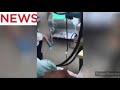 Doctors Remove Snake From Woman’s Mouth