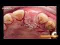 [DENTIS Implant] Implant Placement with GBR Procedure
