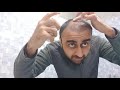 HOW TO USING MINOXIDIL AFTET HAIR TRANSPLANT | USING MINOXIDIL AFTRT ONE MONTH FUE TRANSPLANT