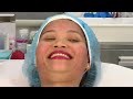 VIVACE MICRONEEDLING TREATMENT FOR SKIN LIFTING
