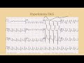 Hyperkalemia - CRASH! Medical Review Series