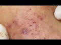 Inflammatory Acne P1 (Minh) | Mụn Viêm Tụ Máu P1 (MINH) - SacDepSpa#329