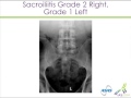 Identification and Classification of Spondyloarthropathies