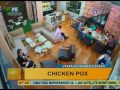 Good Morning Kuya: Chicken Pox - Symptoms and Treatment