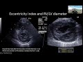 Early markers of pulmonary hypertension in bronchopulmonary dysplasia