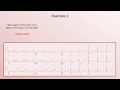 Intro to EKG Interpretation - Myocardial Infarctions (Part 1 of 2)