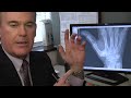 Treating Basal Thumb Joint Arthritis - Mayo Clinic