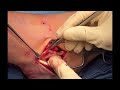Surgical Repair of Chronic Peroneus Brevis Tear