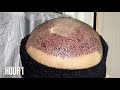 From Day 1 to 30 | 1 month FUE HAIR TRANSPLANT UPDATE AND RESULTS