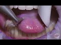 How teeth should be cleaned at the Dentist / Hygienist