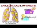 Lung Cancer - All Symptoms