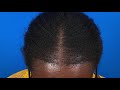 Kylie's 12-Month Hair Transplant Results - Traction Alopecia - Black Women Hair Transplant Results