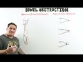 Bowel Obstruction | Clinical Medicine