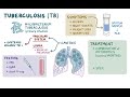 Tuberculosis - causes, symptoms, diagnosis, treatment, pathology