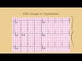 Hypokalemia - CRASH! Medical Review Series