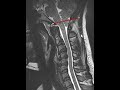 Chiari 1 Malformation - Brain MRI scan | First Look MRI