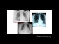 Interstitial Lung Disease with Dr. Sally Suliman