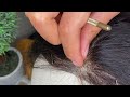 ||HOW TO FIX YOUR WIG CLOSURE||ADD HAIR TO YOUR LACE