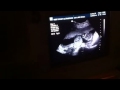 Our twins at 16 weeks gestation