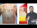 Cancer ( कैंसर ) | Cnacer in hindi | Benign Tumor | Malignant Tumor | Types of Cancer | Treatmnt