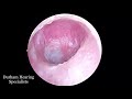 Thick Dead Skin Sheet Peeled Off Eardrum (Suction Extraction)
