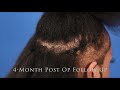 Halle's 4 Month Hair Transplant Results - Hair Transplant Black Women
