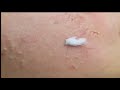 Acne clear - Blackhead removal - Beauty care video #63