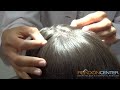 Alopecia explained and Scalp Exam