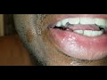 Tonsil Stone Removal