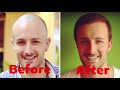 David DiMuzio Hair Transplant Experience with Dr. McGrath Austin, TX