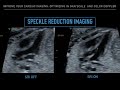Improve Your Fetal Cardiac Imaging Optimizing in Grayscale and Color Doppler
