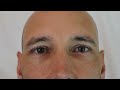 Pupillary Assessment (PERRLA)