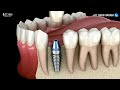 Right Implant  For you? Endoseous or Subperiosteal or Basal Implants Dental Surgeon Dr Sathyaseelan