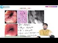 5. Mallory Weiss Tear & Boerhaave Syndrome : USMLE Step 1 Pathology