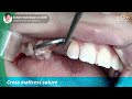 Suture technique on GBR - [Dr. Kim Jaeyoon]