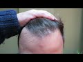 HAIR TRANSPLANT With 4500 Grafts NW4-5, Excellent Result With Fine Hair !