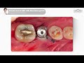 Simple buccal GBR with membrane punch [Dr. Kim Jaeyoon]