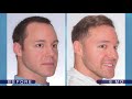 Hairline Hair Transplant - ARTAS Robotic FUE (6 Months Post Procedure)