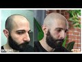 CAN'T BELIEVE this Scalp Micropigmentation Result in Los Angeles, CA