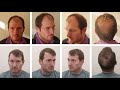 US Patient FUT Hair Transplant, Great Before and After Results - Dr. Ali Emre Karadeniz
