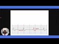 Ventricular Rhythms - EKG Interpretation | @LevelUpRN