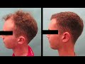 Hair Transplant Results - 12-Month FUT Surgery Follow-up Before and After