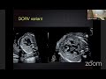 FETAL ECHO - OUTFLOW TRACTS - REVIEW by Dr Balu Vaidyanathan