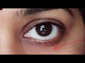 Dark circles under eyes(కళ్ళ కింద నల్లని వలయాలు) in telugu.||Suni's Health and Home Science.